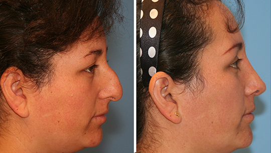 rhinoplasty-last-8 rhinoplasty-last-8