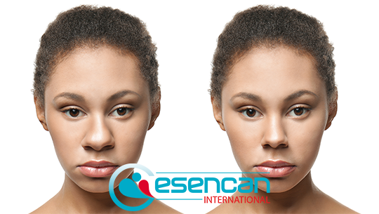 rhinoplasty-right-7 rhinoplasty-right-7