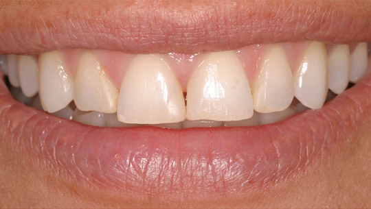 before-d1