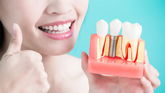 dental-implant-1 dental-implant-1