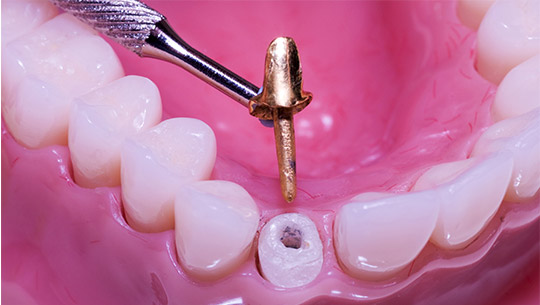 dental-zirconium-3 dental-zirconium-3