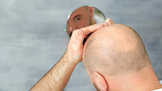 hair-transplant-5 hair-transplant-5