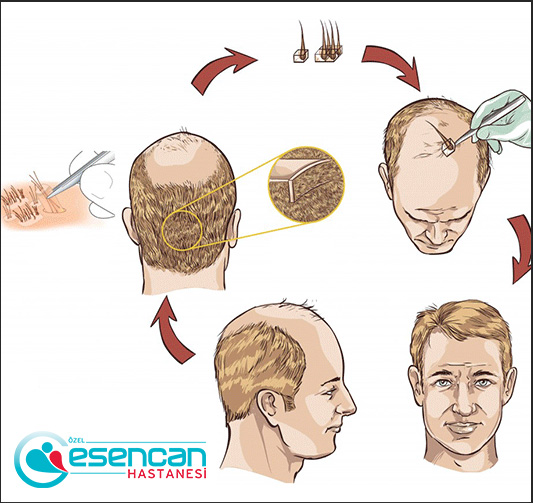 hair-transplant-9 hair-transplant-9