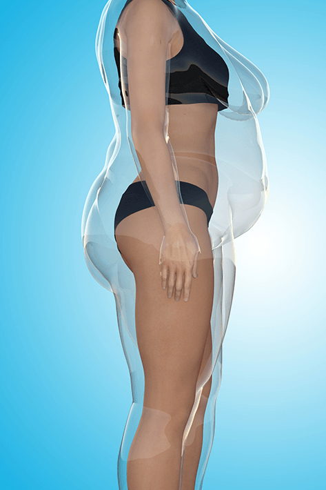 liposuction-left-4 liposuction-left-4