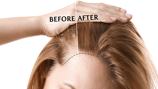 women-hair-transplant-1 women-hair-transplant-1