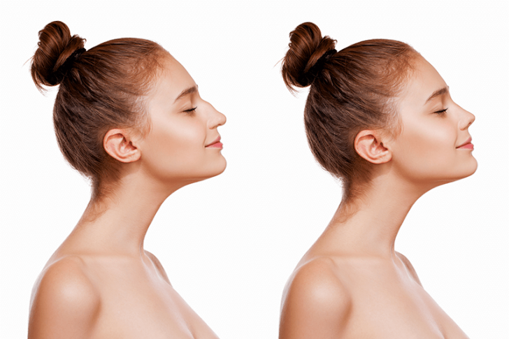 rhinoplasty-1